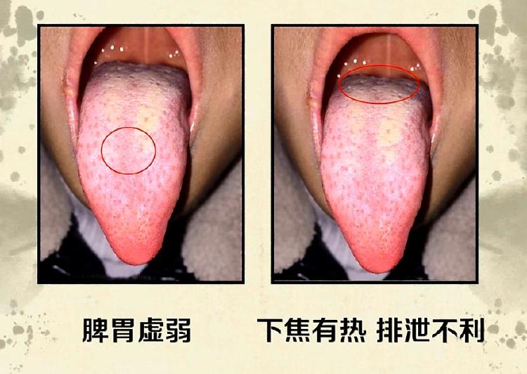 小儿舌诊病例分析第31课《风热咳嗽》