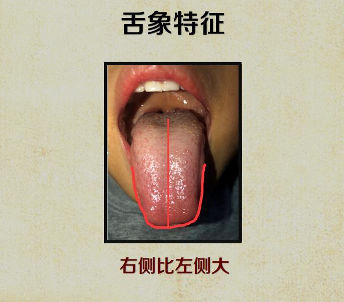 一,舌象特征 舌体大小的标准:舌头两侧-嘴角(口角)的距离