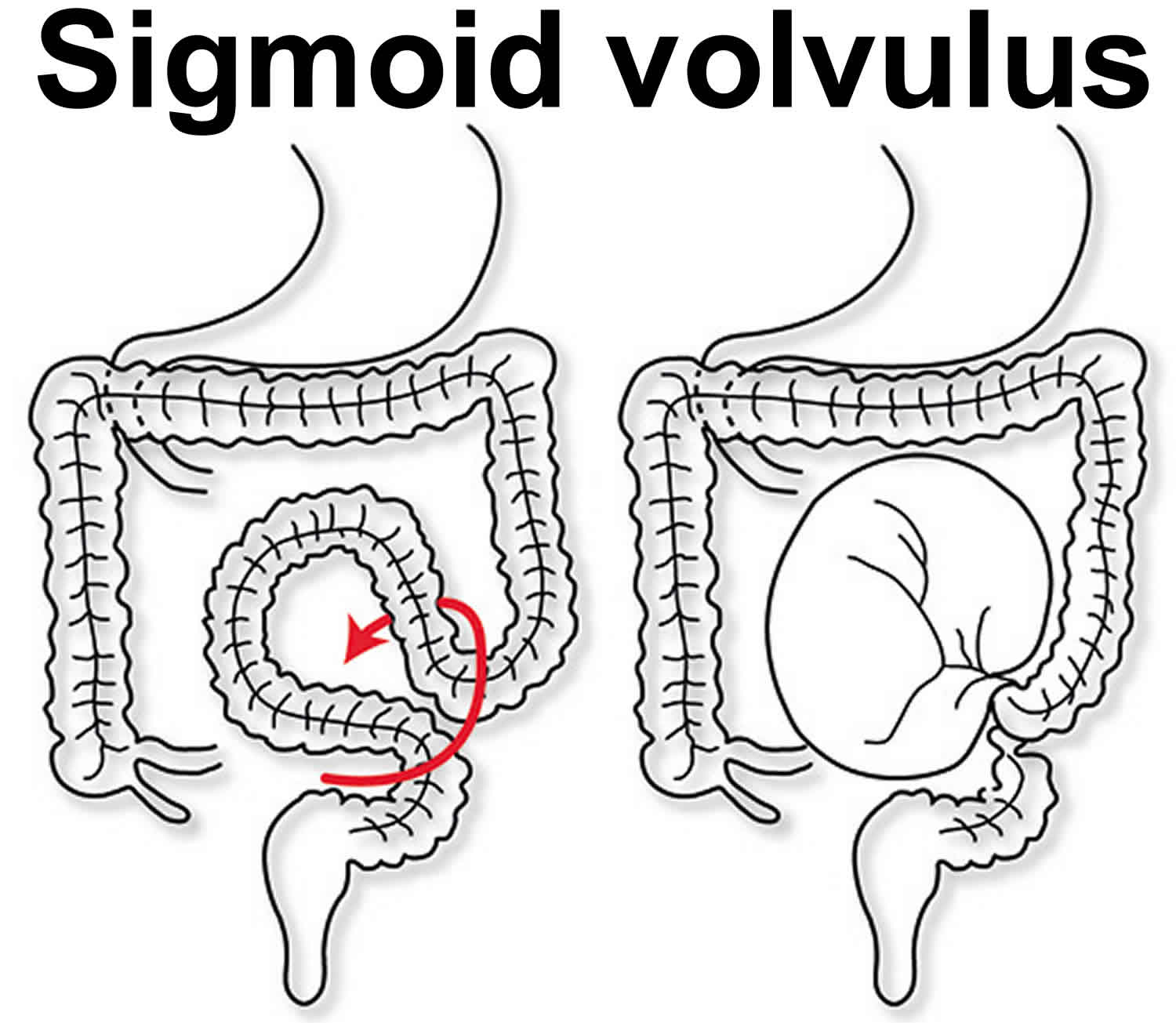 sigmoid-volvulus (1).jpg