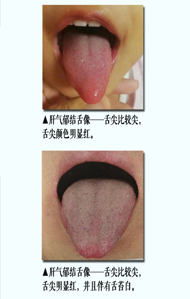 气郁舌像1副本.jpg