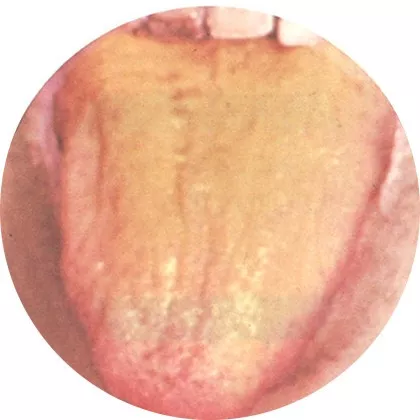 【脾虚的自检自测】看舌苔,调脾胃(附舌诊图)