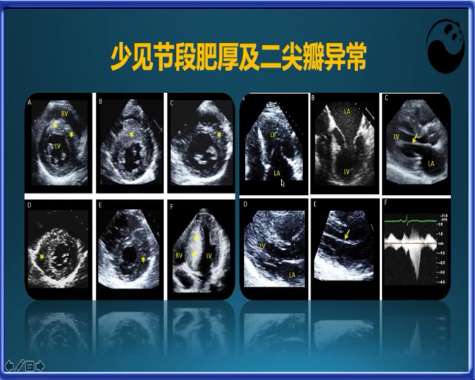 手把手教你肥厚型心肌病的超声心动图诊断_中国超声医学网大咖课程