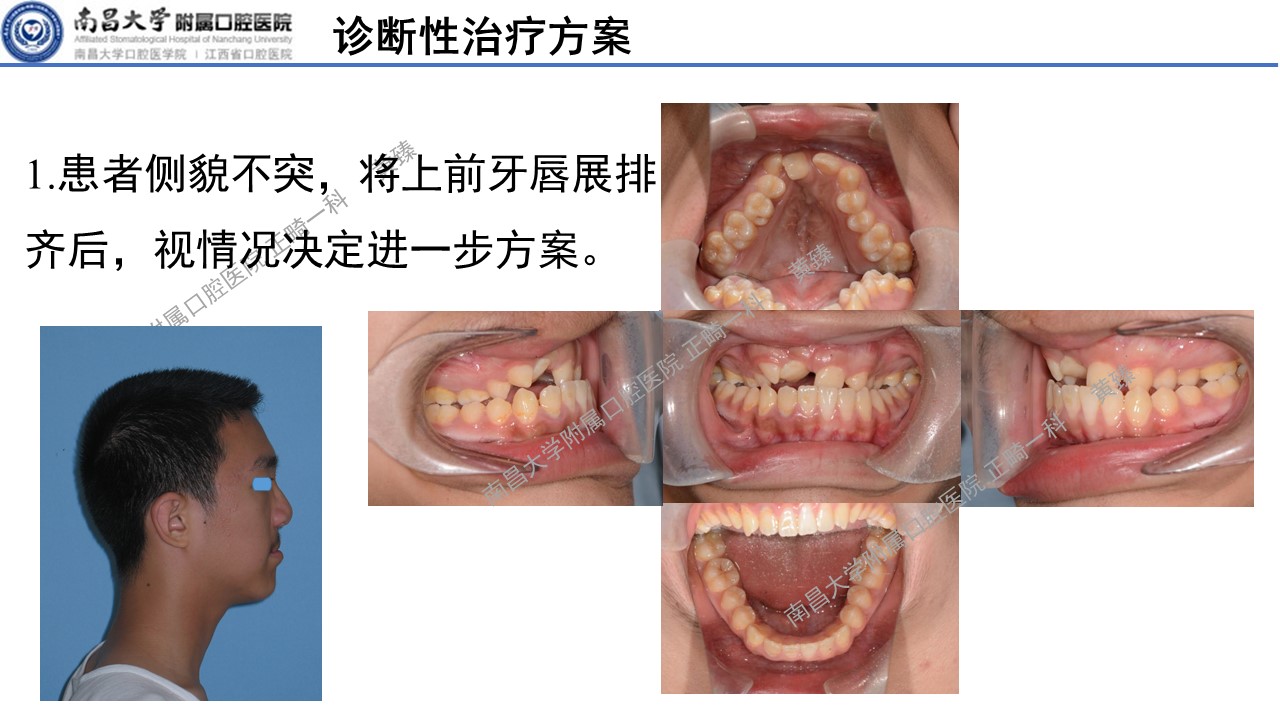 【黄臻 精品课】唇腭裂序列的年轻恒牙期正畸治疗