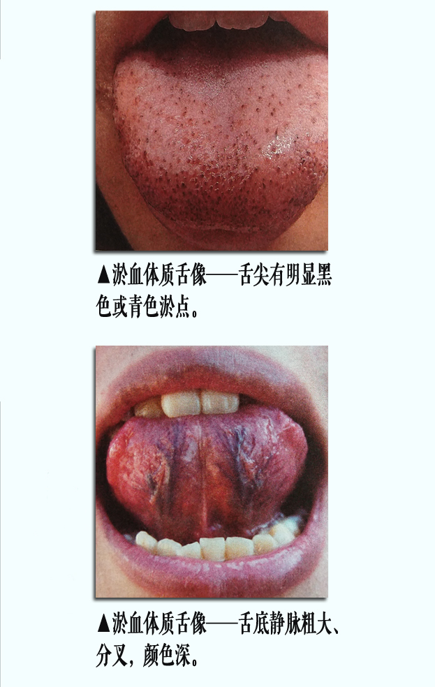 淤血舌像1副本.jpg