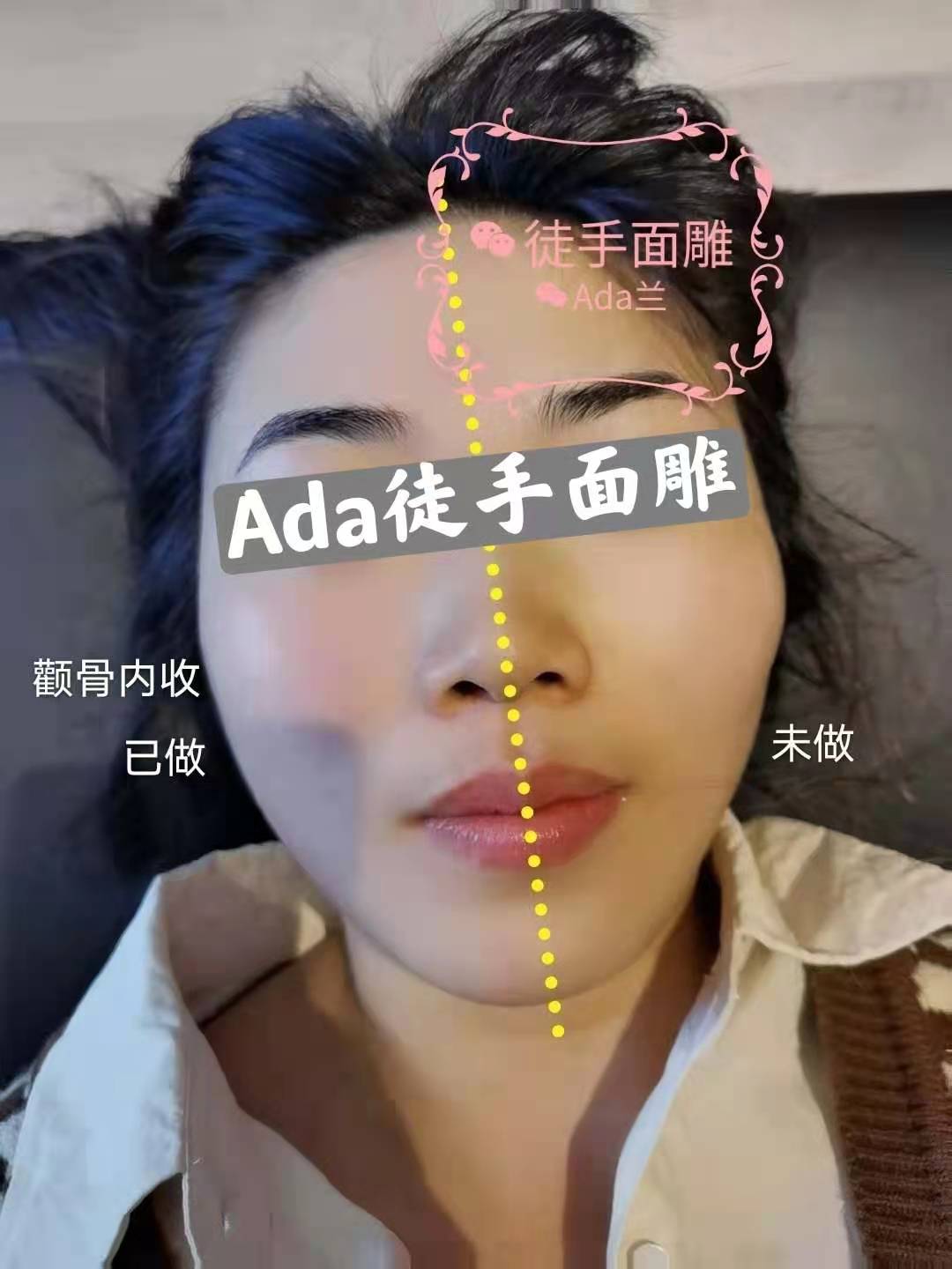 ada徒手面雕-祛除抬头纹