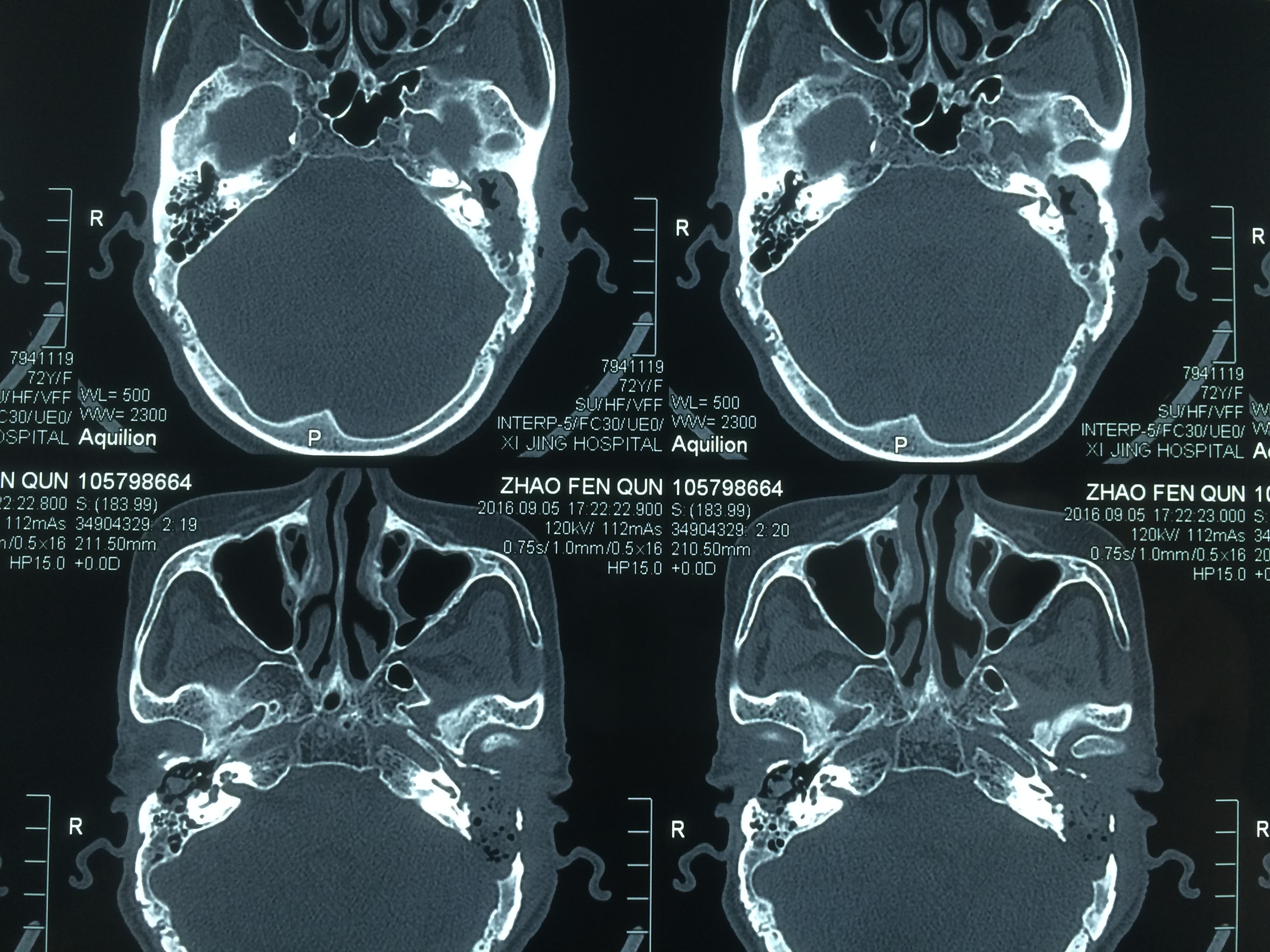 陈阳教授|镫骨和迷路瘘手术19—外耳道胆脂瘤面神经裸露和上皮陷入