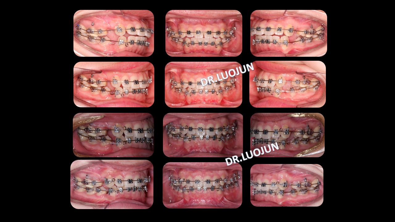 【罗俊 精品课】微种植体支抗在正畸治疗中的运用