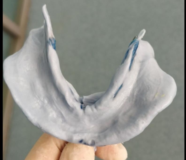 我们将全口义齿印模的精髓通通交给你,听了课再送你实操视频课程,临床