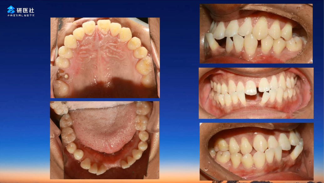 8--牙列间隙的系列矫治