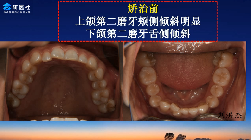 2-后牙锁合的矫治