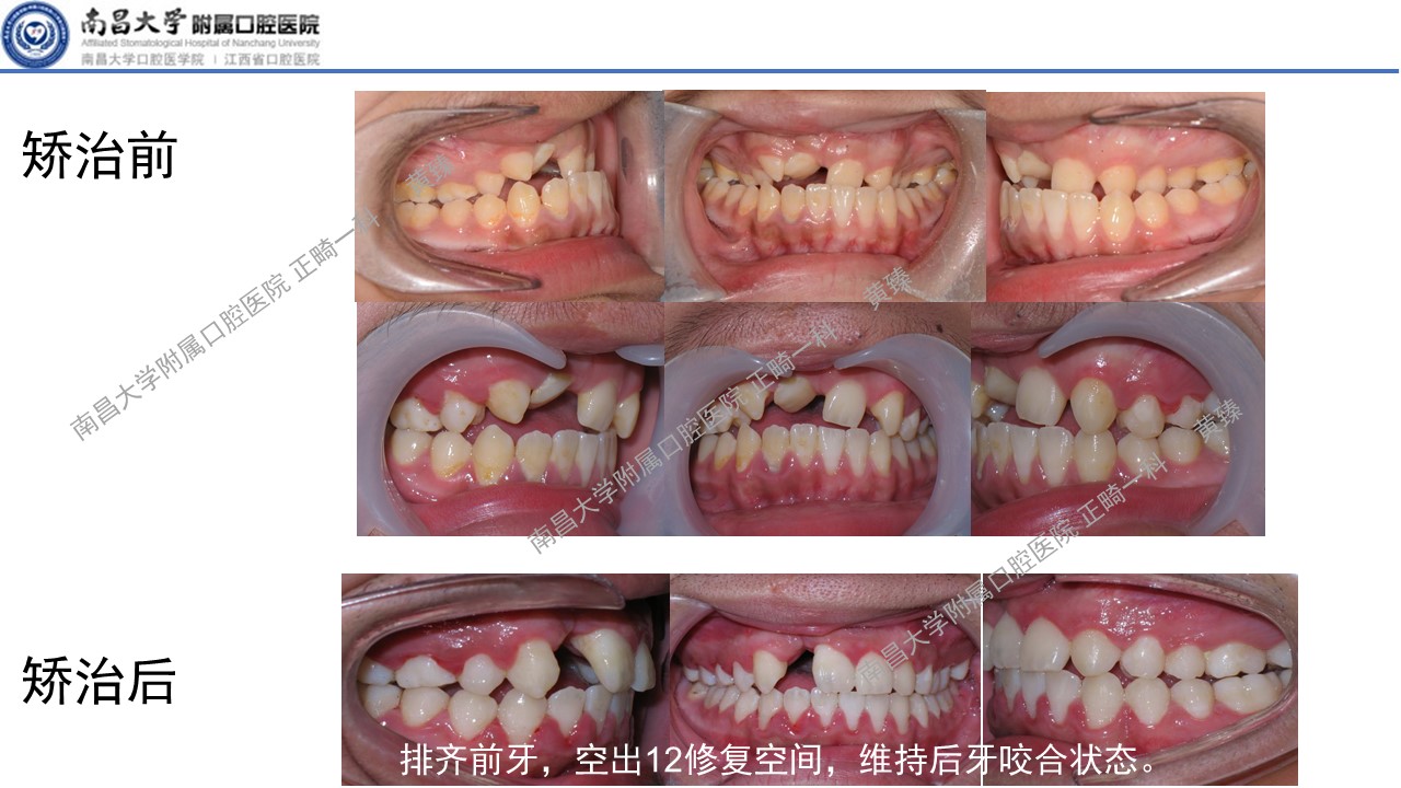 【黄臻 精品课】唇腭裂序列的年轻恒牙期正畸治疗