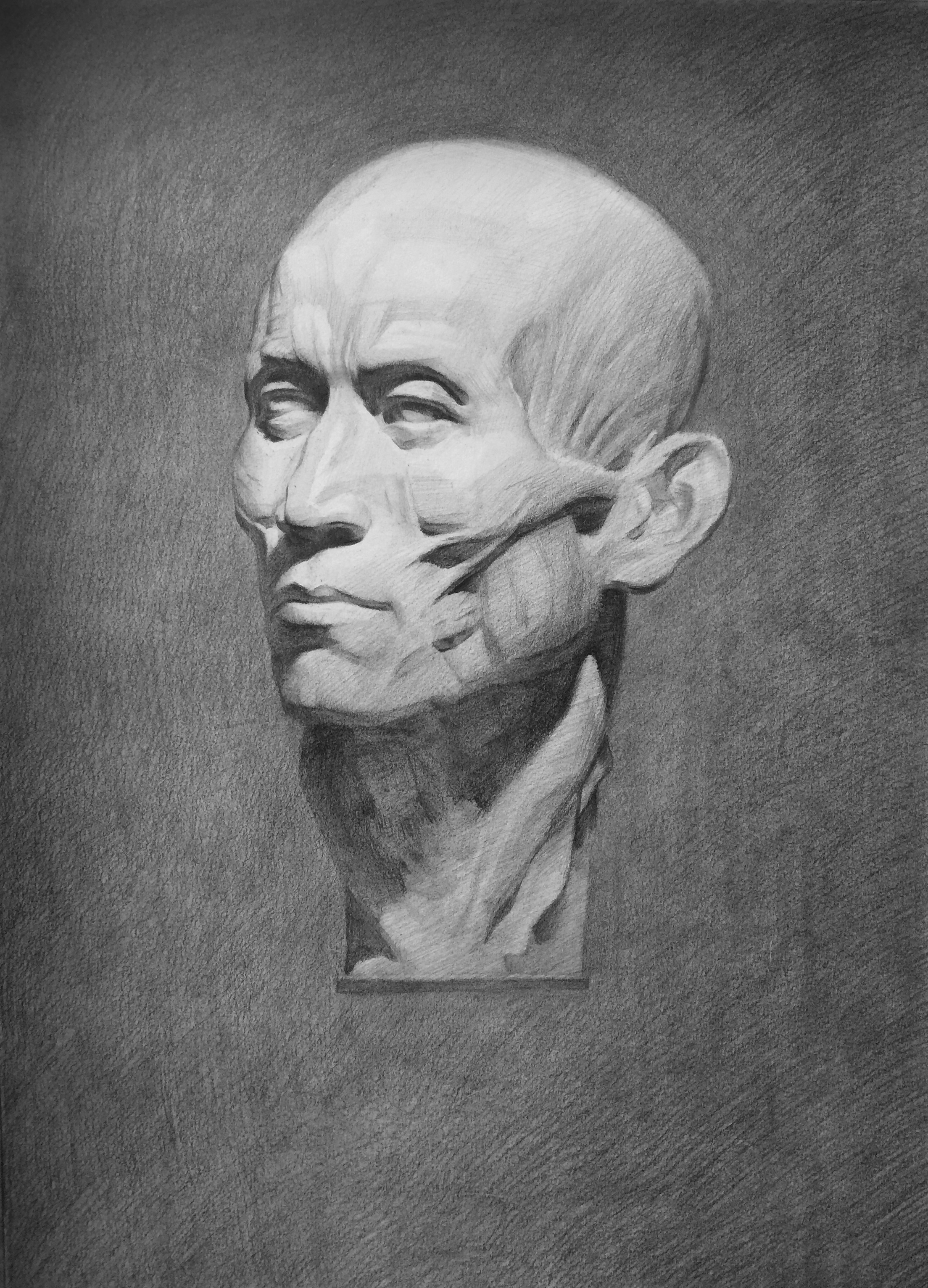 7-4:面部肌肉石膏下