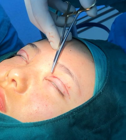 内z无痕双眼皮 muller氏肌缩短术矫正先天性上睑下垂