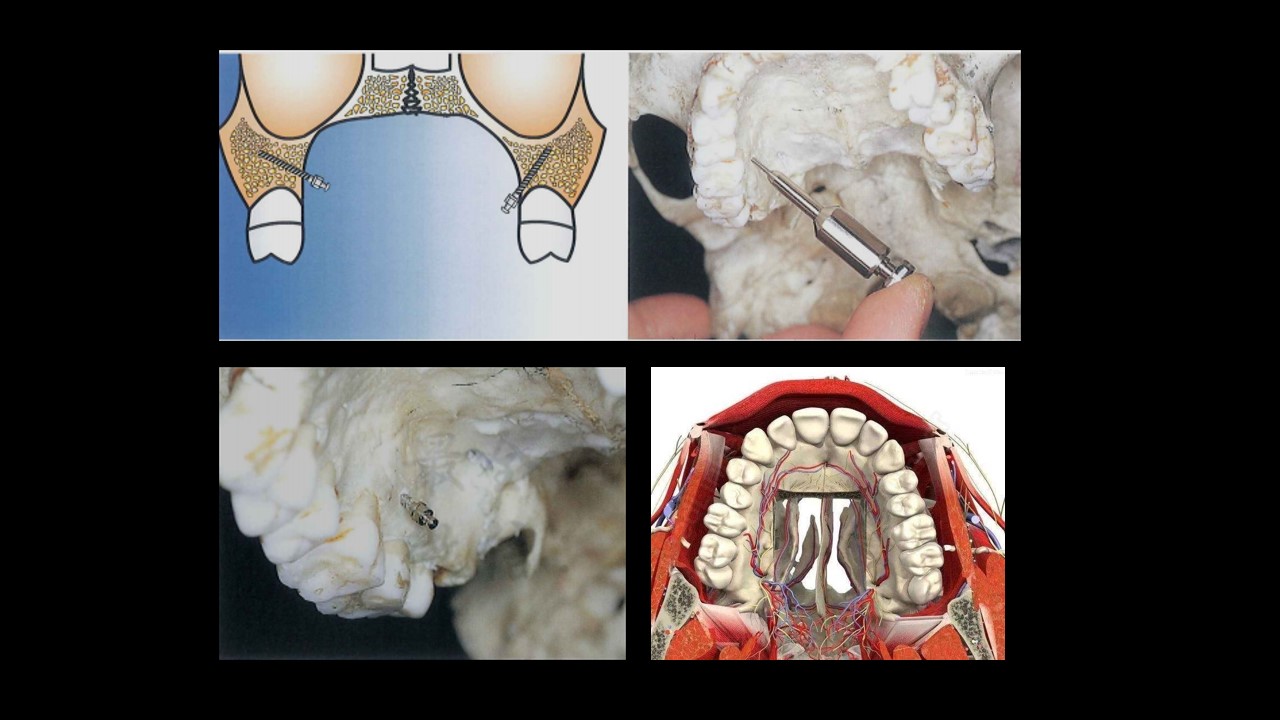 【罗俊 精品课】微种植体支抗在正畸治疗中的运用