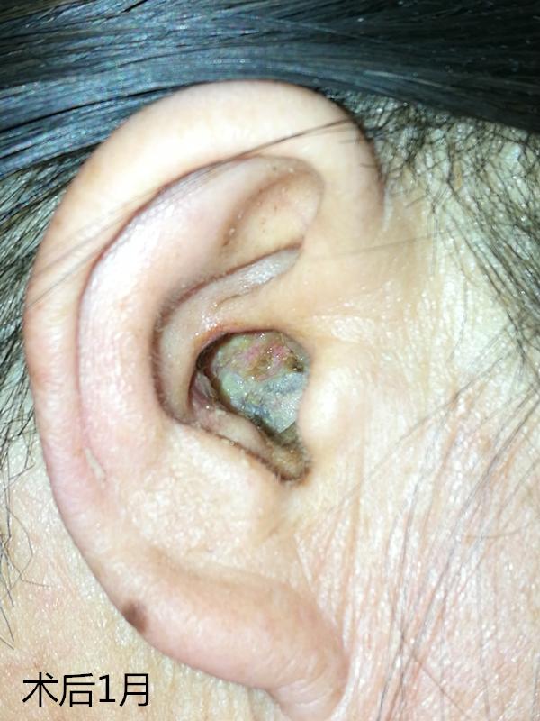 外耳道乳头状瘤的样子图片